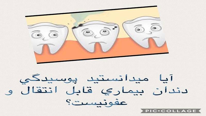 پوسیدگی دندان بیماری قابل انتقال عفونیست؟
