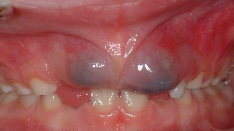 آبسه در دندان شیری ( درمان و پیشگیری )