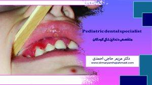 علت خونریزی لثه کودکان چیست؟ بررسی کامل دلایل، علائم و روشهای درمان 2 300x169 - علت خونریزی لثه کودکان چیست؟ بررسی کامل دلایل، علائم و روشهای درمان