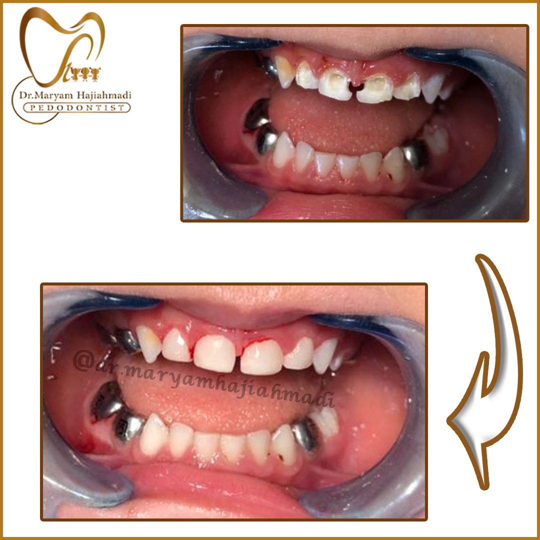 ترمیم زیبایی دندان شیری تحت بیهوشی | متخصص دندانپزشکی کودکان اصفهان | دکتر مریم حاجی احمدی