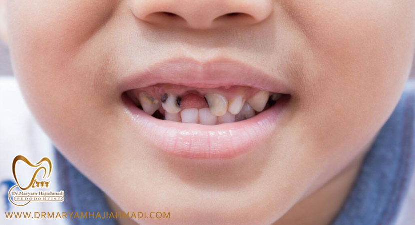 drmaryamhajiahmadi16 - دندان کودکم دچار حفره شده است چه کنم و چگونه می توان از بروز بیشتر جلوگیری کرد؟