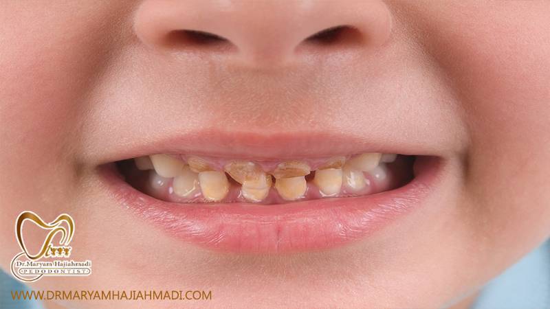 12 - شیردهی و پوسیدگی دندان - آیا شیردهی با پوسیدگی دندان ارتباط دارد؟