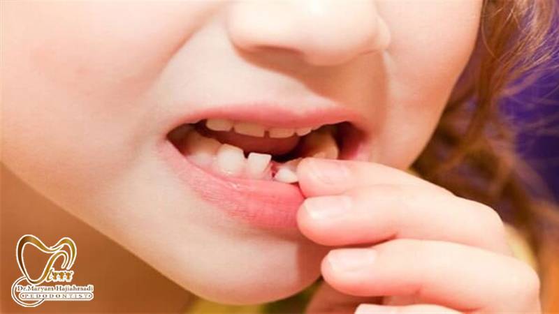 کشیدن دندان شیری کودکان