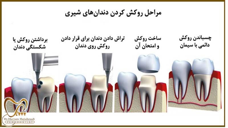 دندان در کودکان - چه مدت روکش دندان کودکان در جای خود باقی می مانند؟