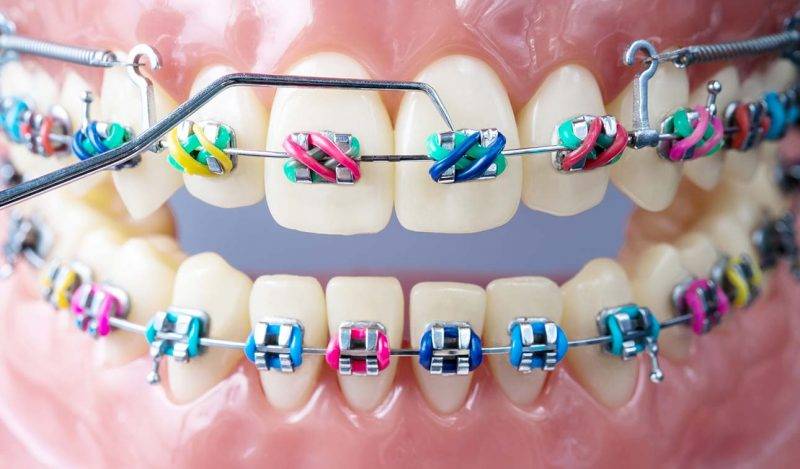 دندانپزشکی ارتودنسی1 scaled - ارتباط دندانپزشکی کودکان با ارتودنسی چیست؟
