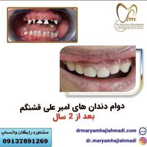 Snapinsta.app 291494016 142235671790419 8243380214902793595 n 1080 300x300 - تشخیص علائم پوسیدگی دندان شیری در کودکان