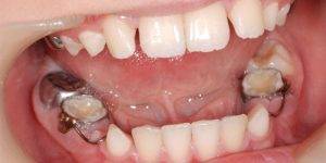 space maintainer4 300x150 - فضا نگهدارنده دندان کودکان چیست و چه کاربردی دارد؟