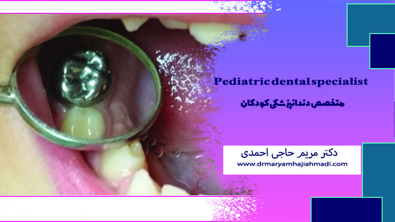روکش کردن دندان عصب‌کشی