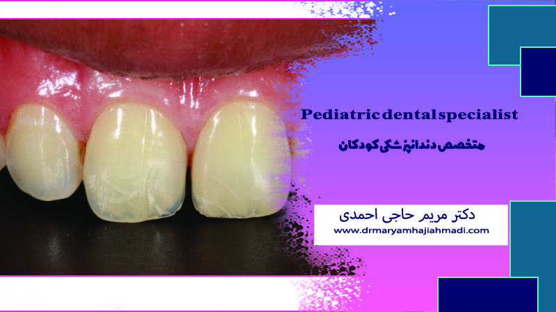 Imprimir ترک خوردگی مینای دندان کودکان