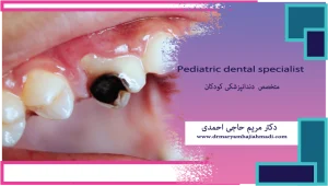 دلایل اصلی پوسیدگی دندان در کودکان و راههای پیشگیری نشانه خطرناک پوسیدگی دندان 300x170 - دلایل اصلی پوسیدگی دندان در کودکان و راههای پیشگیری